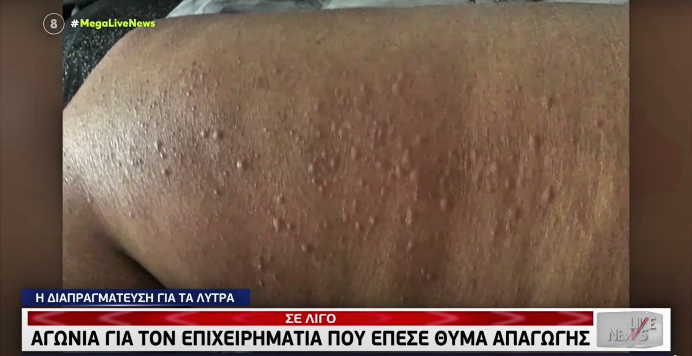 Μετάλλαξη Όμικρον: Αυτά είναι τα εξανθήματα που προκαλεί σε κάποιες περιπτώσεις (vid)
