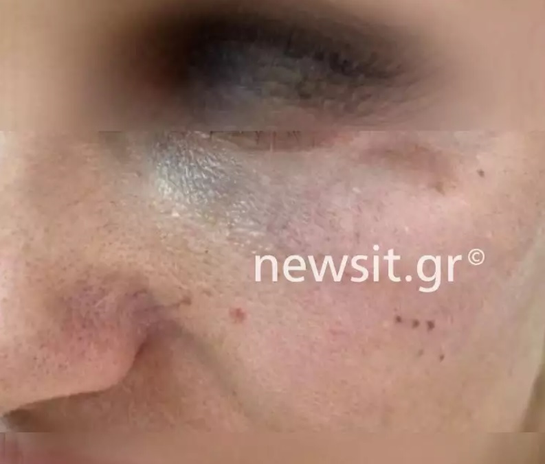 Θέμης Αδαμαντίδης: Τα χτυπήματα στο πρόσωπο της πρώην συντρόφου του