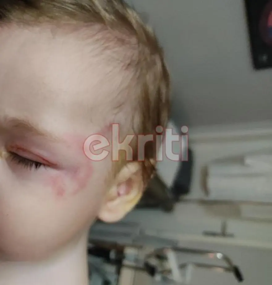Κρήτη: Στο ΠΑΓΝΗ με τραύματα σε πρόσωπο και σώμα το βρέφος που δέχθηκε επίθεση από λυκόσκυλο (pics)