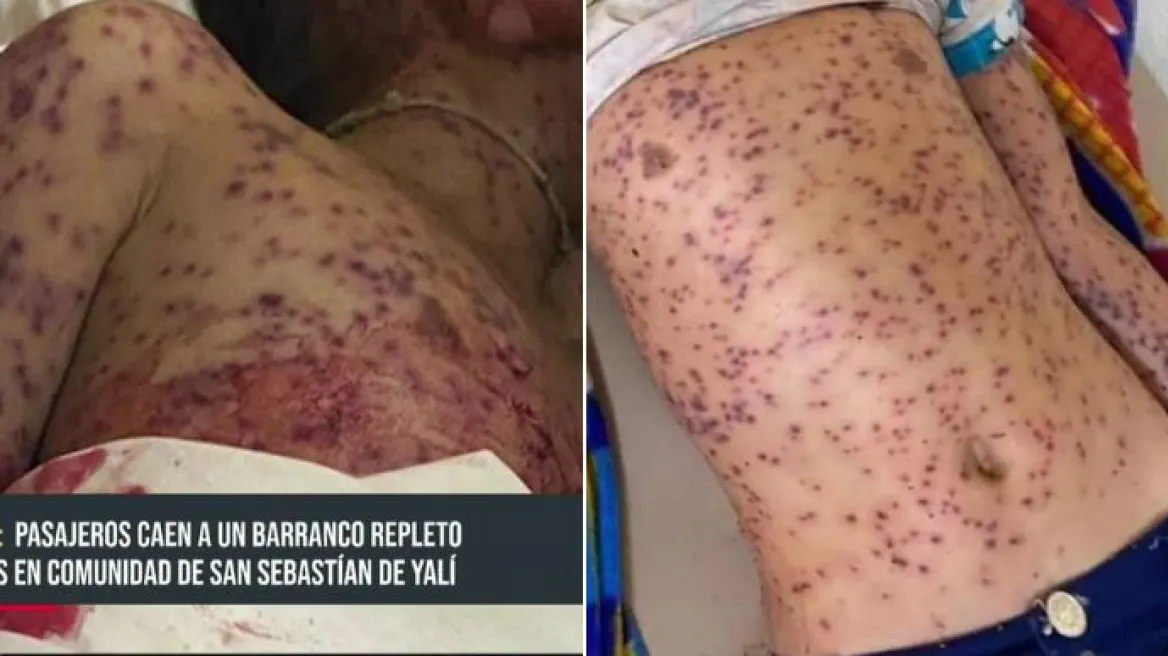 Σοκάρουν οι εικόνες από την Νικαράγουα: Έξι νεκροί από τσιμπήματα μελισσών όταν λεωφορείο έπεσε σε μελίσσια – Στα θύματα και 8χρονο παιδί