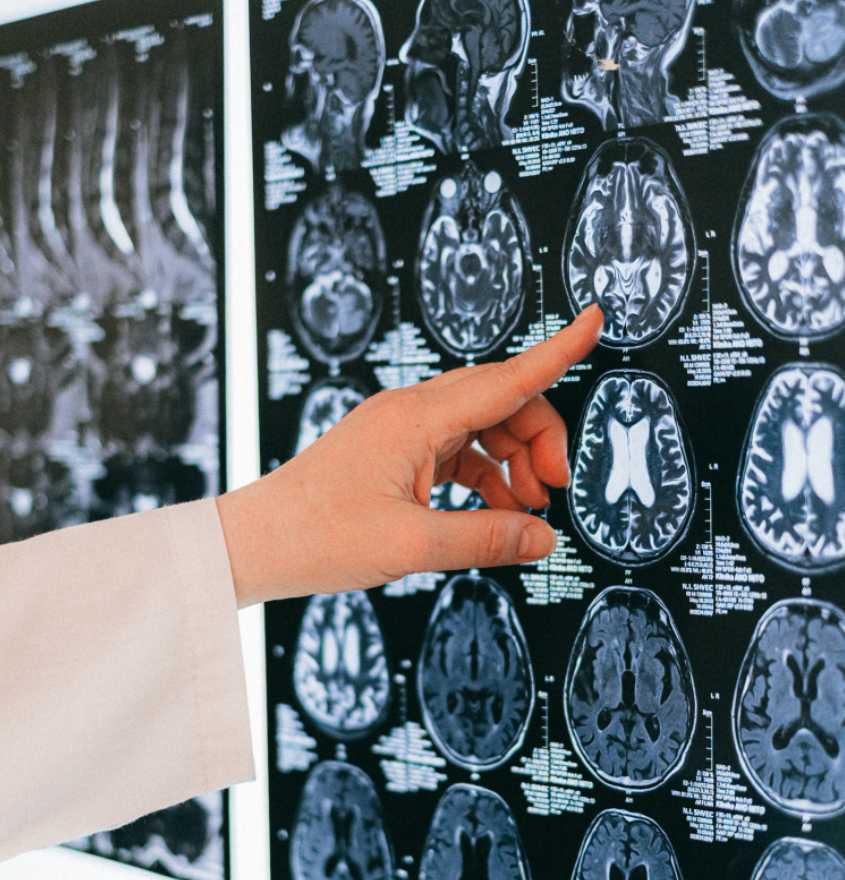 Ιστορική Διάγνωση: 19χρονος νεότερος ασθενής με Αλτσχάιμερ