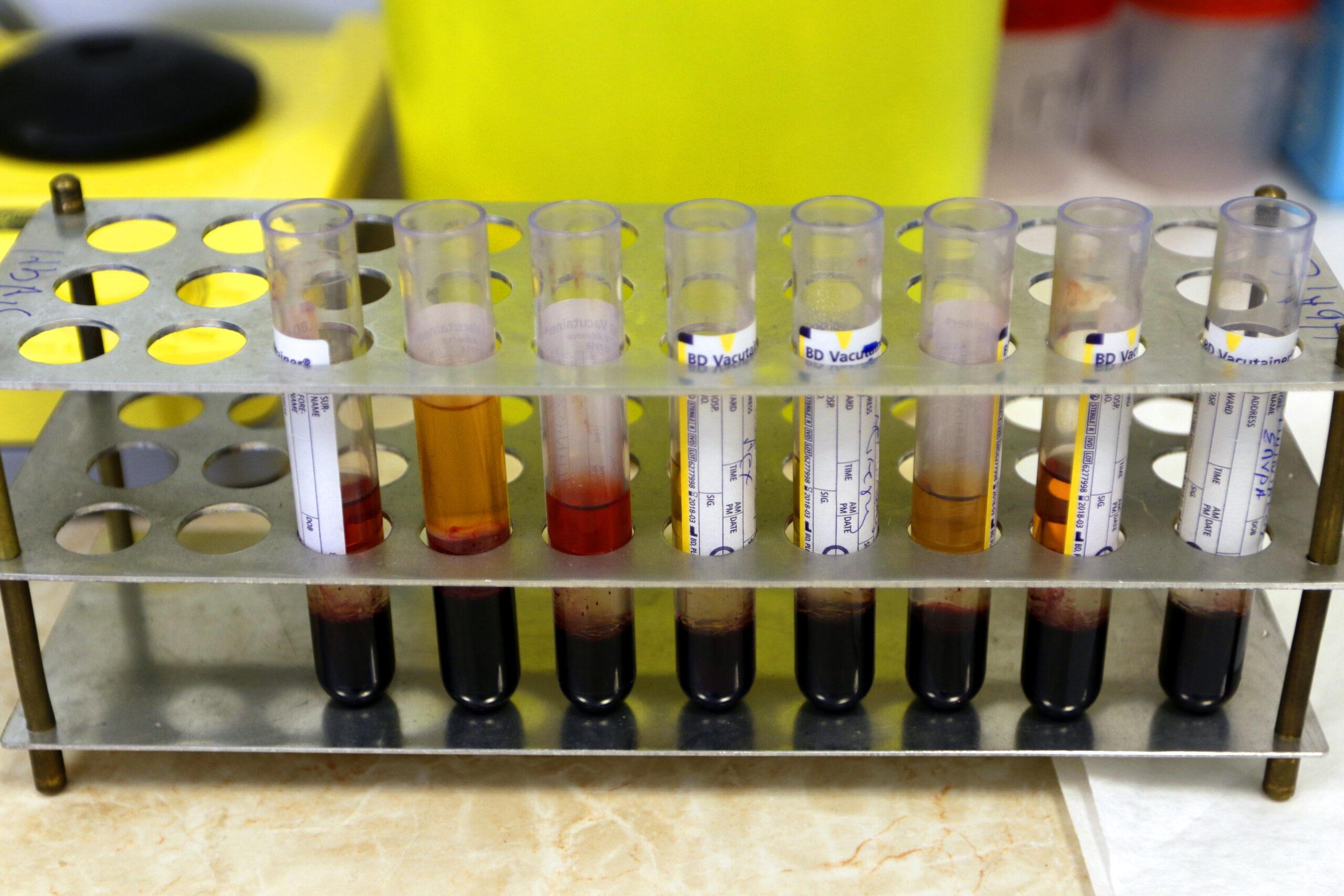 Δωρεάν εξέταση για HIV, ηπατίτιδα Β & C και σύφιλη από τον Δήμο Θεσσαλονίκης