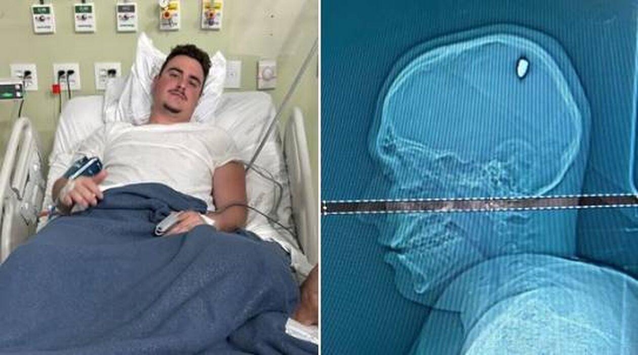 Βραζιλία: Φοιτητής είχε τέσσερις μέρες σφαίρα σφηνωμένη στο κεφάλι του