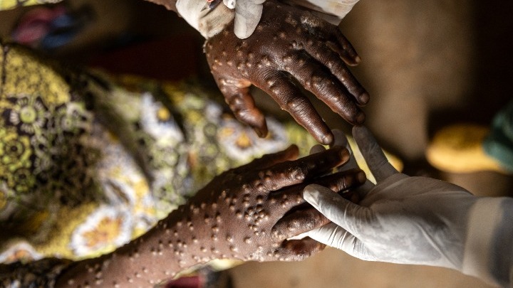 Εξάπλωση της mpox στην Κεντροαφρικανική Δημοκρατία: Ένας θάνατος και 53 επιβεβαιωμένα κρούσματα