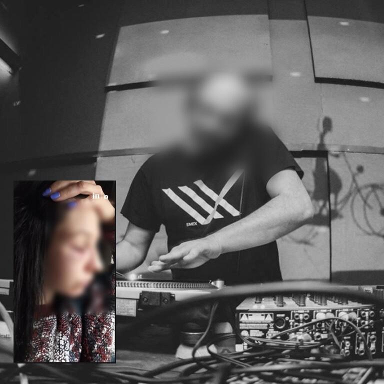 Διάσημος dj κατηγορείται για ξυλοδαρμό της συντρόφου του – Σοκαριστικές φωτογραφίες με μώλωπες της 33χρονης