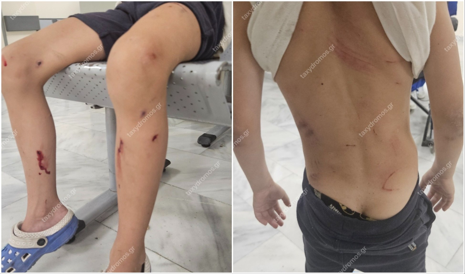 Βόλος: Επιθέσεις από αδέσποτα σκυλιά σε 7χρονο αγόρι
