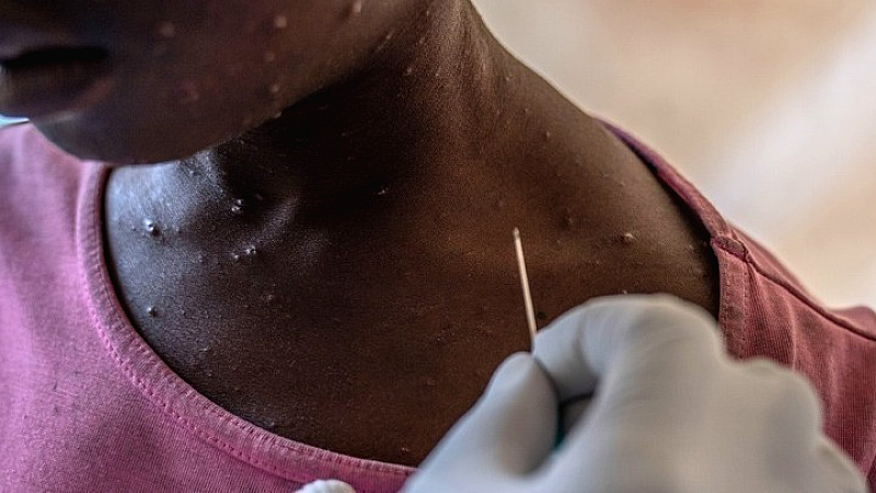 Συναγερμός στη Γκάμπια λόγω του κρούσματος mpox