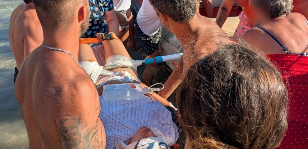 Σοκαριστικό ατύχημα στη Δονούσα: Ομπρέλα καρφώθηκε στο πόδι λουόμενης – Καταγγελία για τις ελλείψεις στο ΕΣΥ