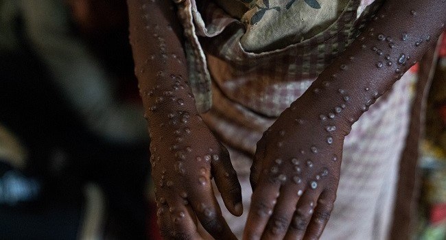 Ο πρώτος θάνατος από mpox καταγράφηκε στην Γκάνα