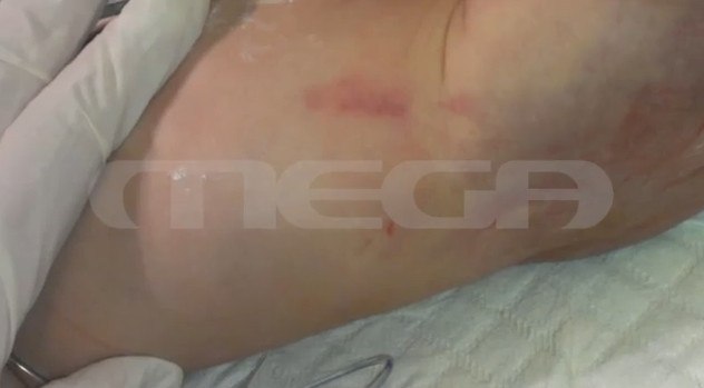 Αποκαλύψεις για το θάνατο βρέφους 2,5 μηνών από κακοποίηση: Τι υποστήριζε ο ιατροδικαστής