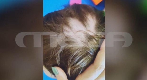 Αυλώνας: Το παιδάκι ήταν σε καλή κατάσταση και ξαφνικά γύρισε με χτυπημένα χείλια, δηλώνει η βρεφονηπιοκόμος