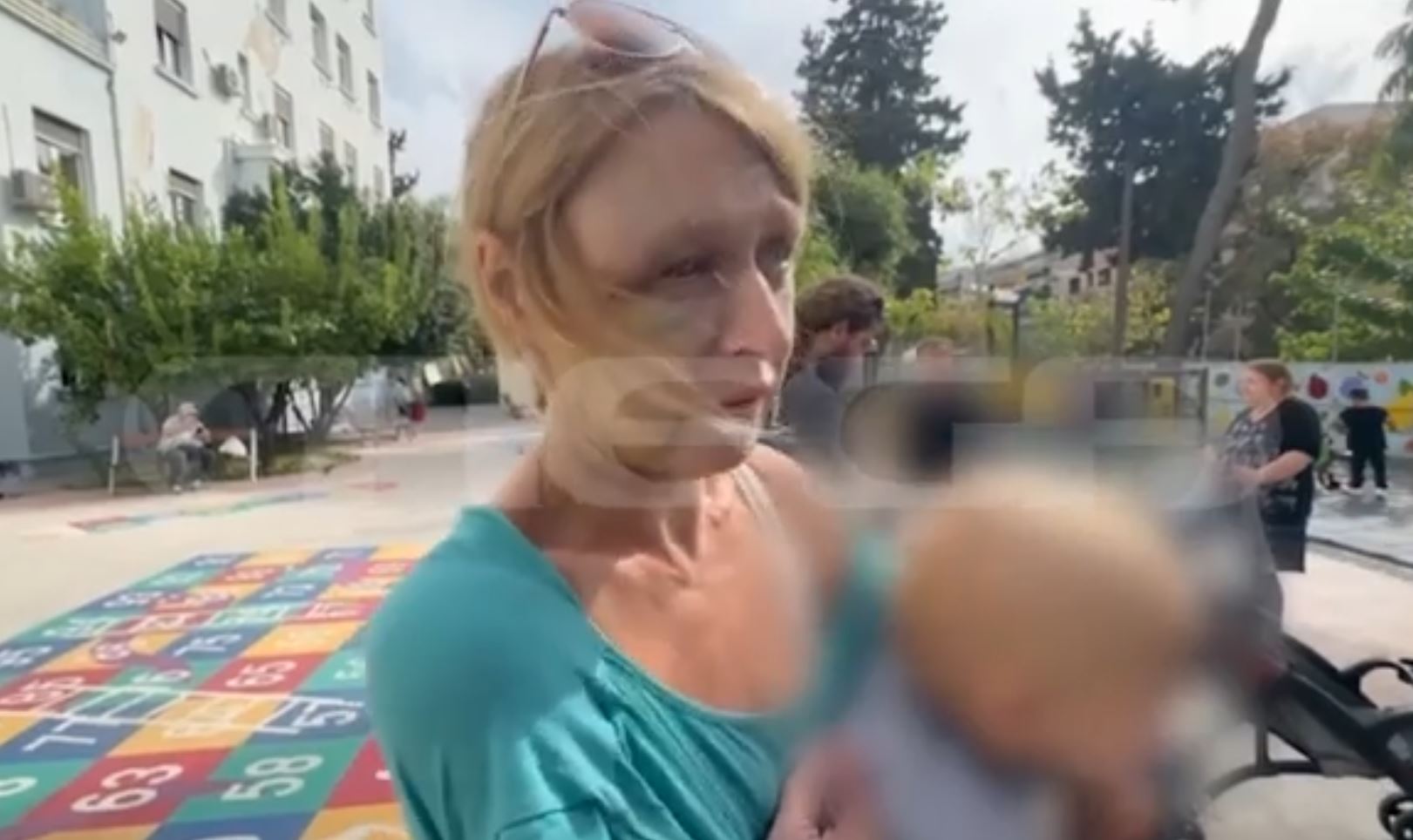 Η 40χρονη που δέχθηκε ξυλοδαρμό στο Κορωπί δηλώνει: Δεν θυμάμαι ποιος με χτύπησε