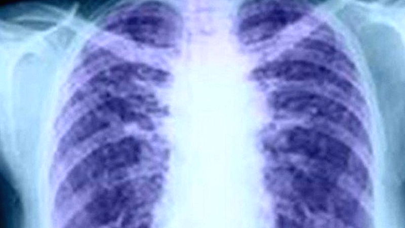 Η επανάσταση στη θεραπεία του καρκίνου του πνεύμονα – Από τη διάγνωση στην επιβίωση μέσω ιατρικής ακριβείας και ανοσοθεραπείας