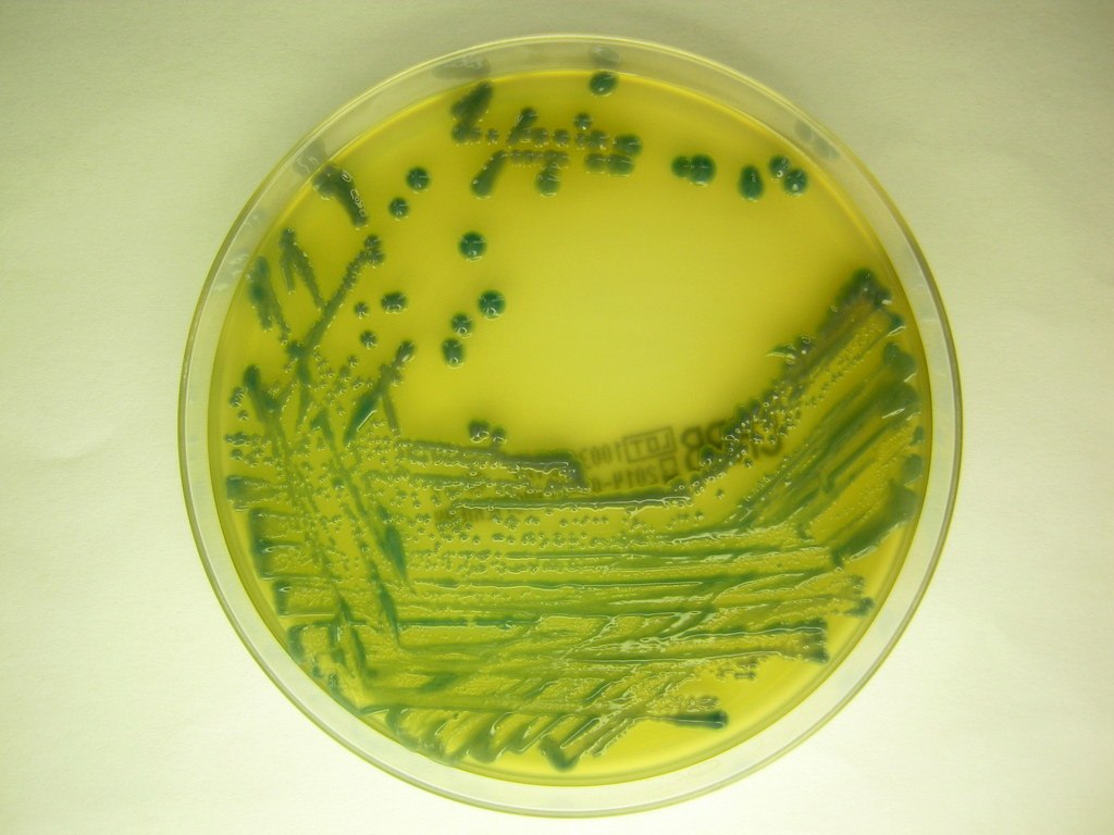 Μείωση 40% των νοσοκομειακών λοιμώξεων αποτρέπει 17.000 ημέρες νοσηλείας από επιπλοκές